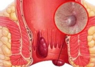 What does hemorrhoids look like